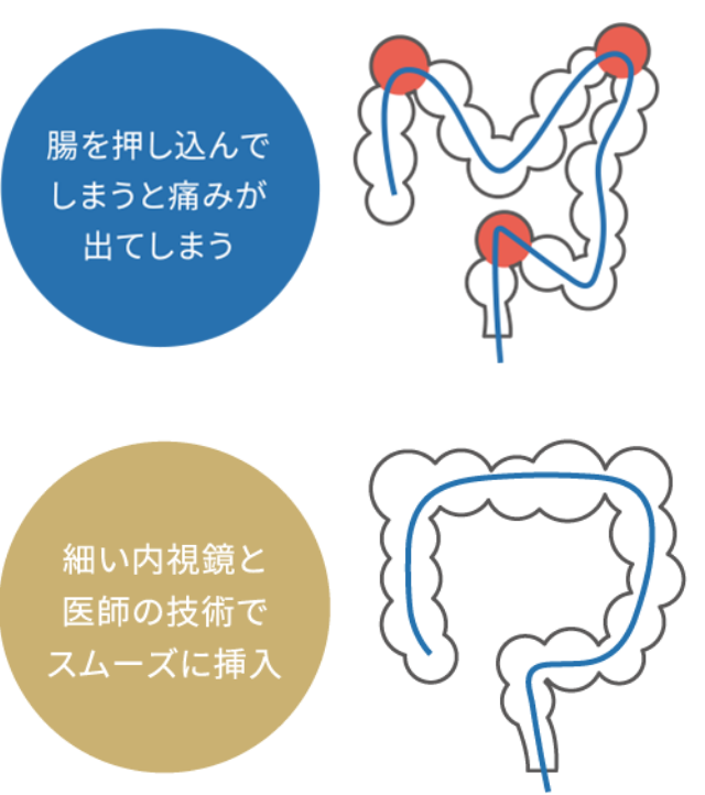 腸を押し込んでしまうと痛みが出てしまう／細い内視鏡と医師の技術でスムーズに挿入